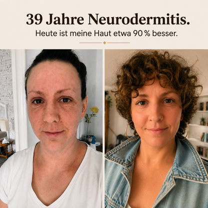 Neurodermitis E-Book "Wenn ich das früher gewusst hätte"