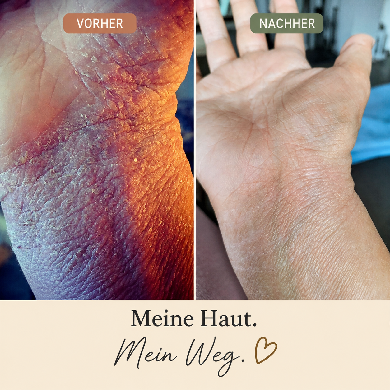 Neurodermitis E-Book "Wenn ich das früher gewusst hätte"