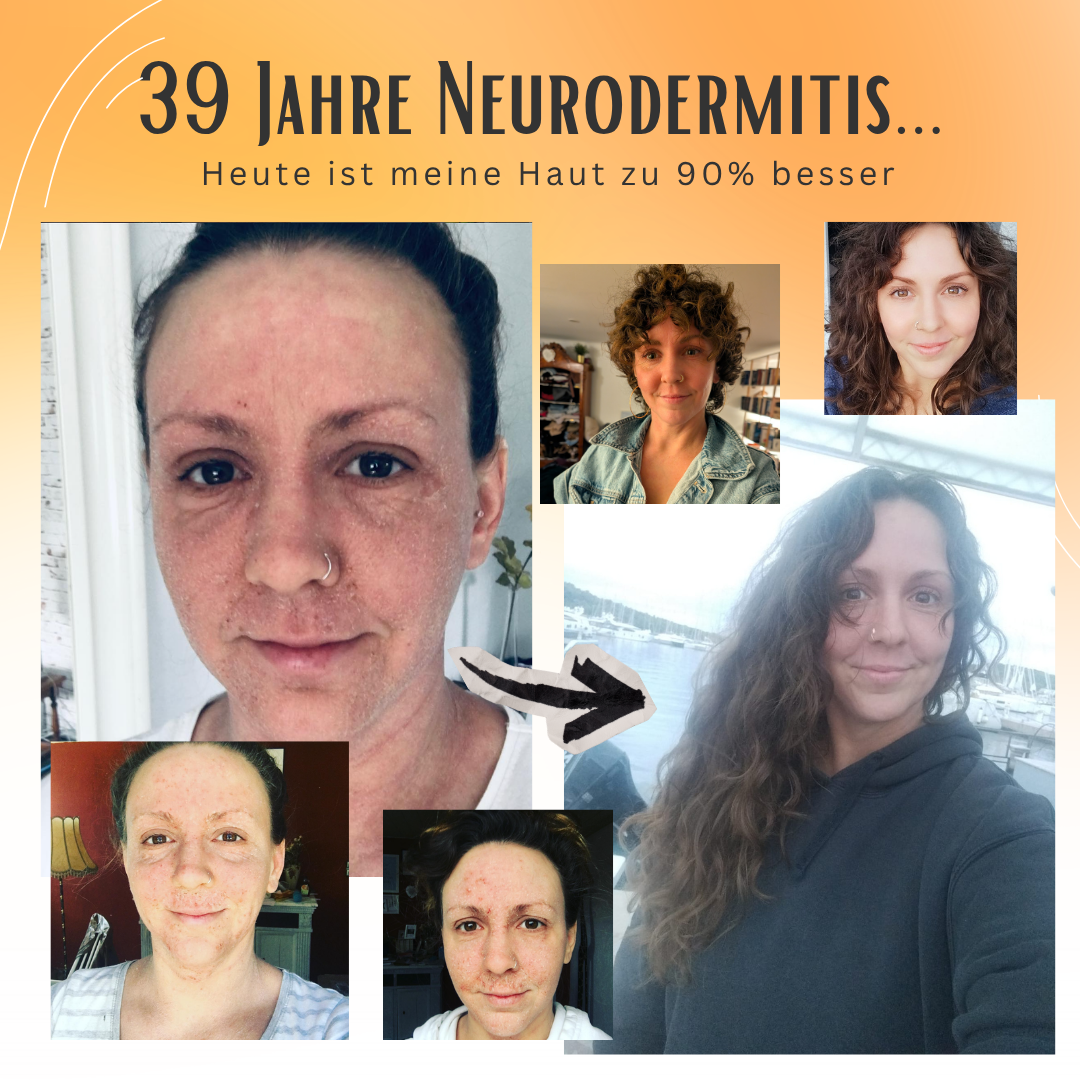 Neurodermitis E-Book "Wenn ich das früher gewusst hätte"